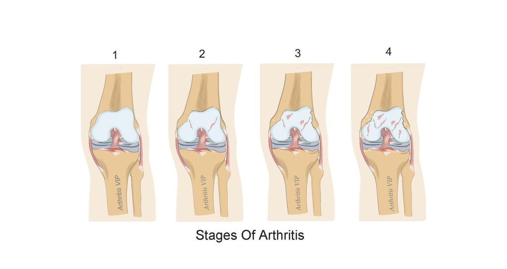 2 Arthritis Stages copy