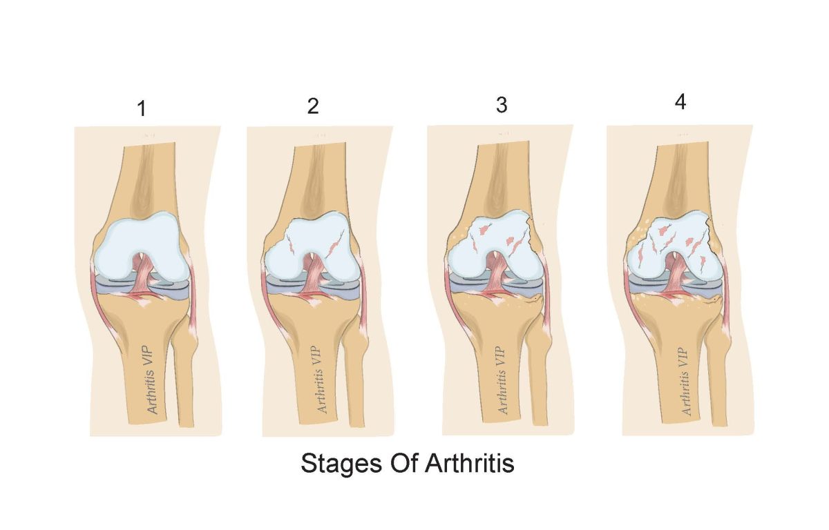 2 Arthritis Stages copy