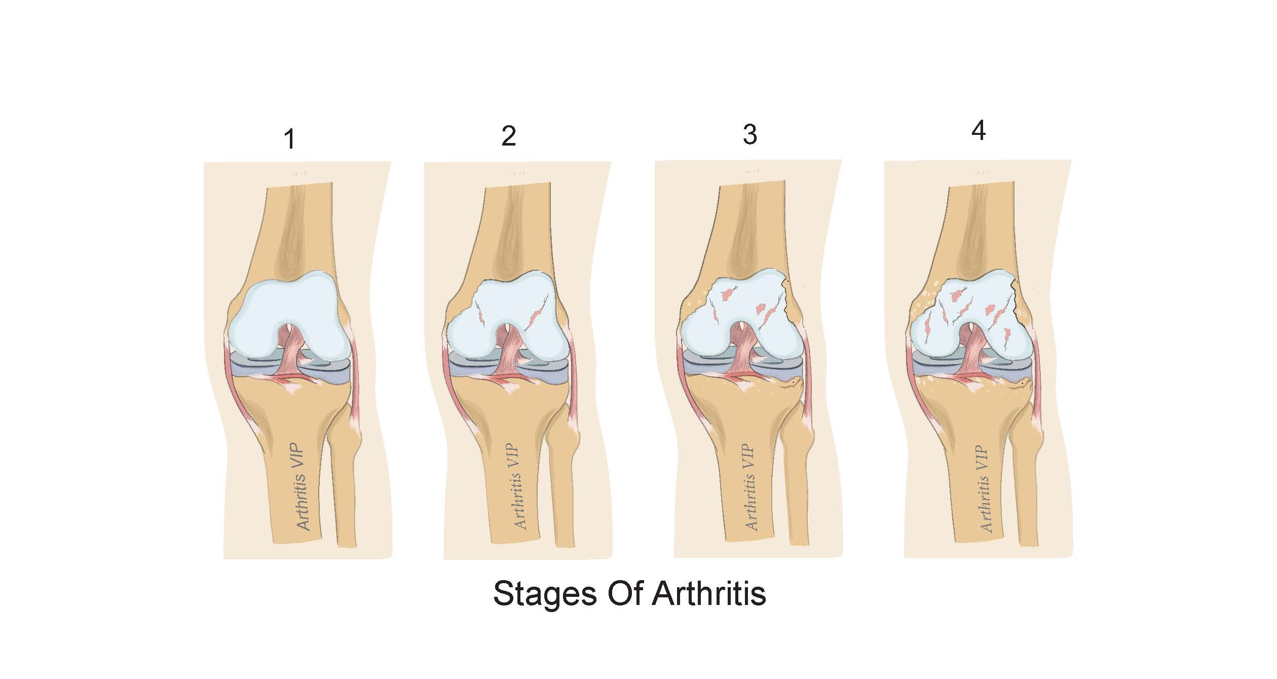 2 Arthritis Stages copy