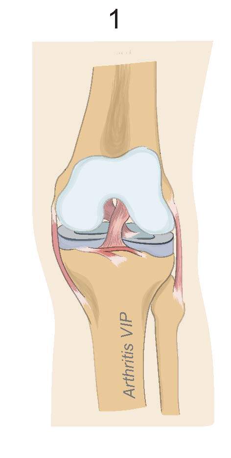 Stage 1 osteoarthritis