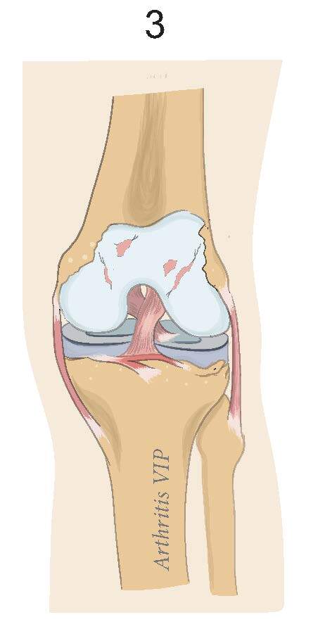 Stage 3 osteoarthritis