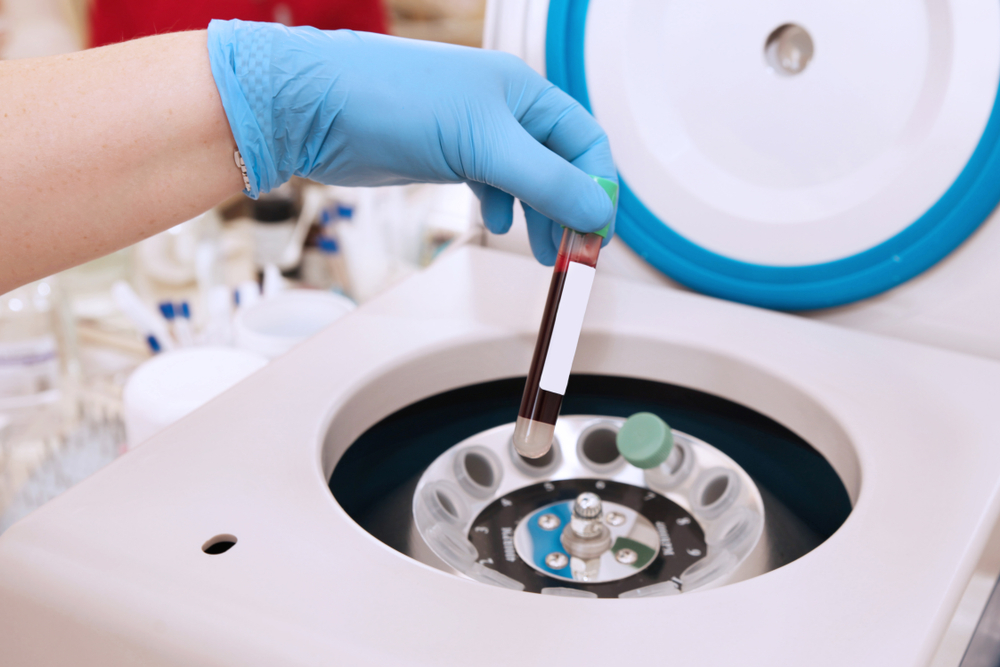 Platelet Rich Plasma for Arthritis Pain
