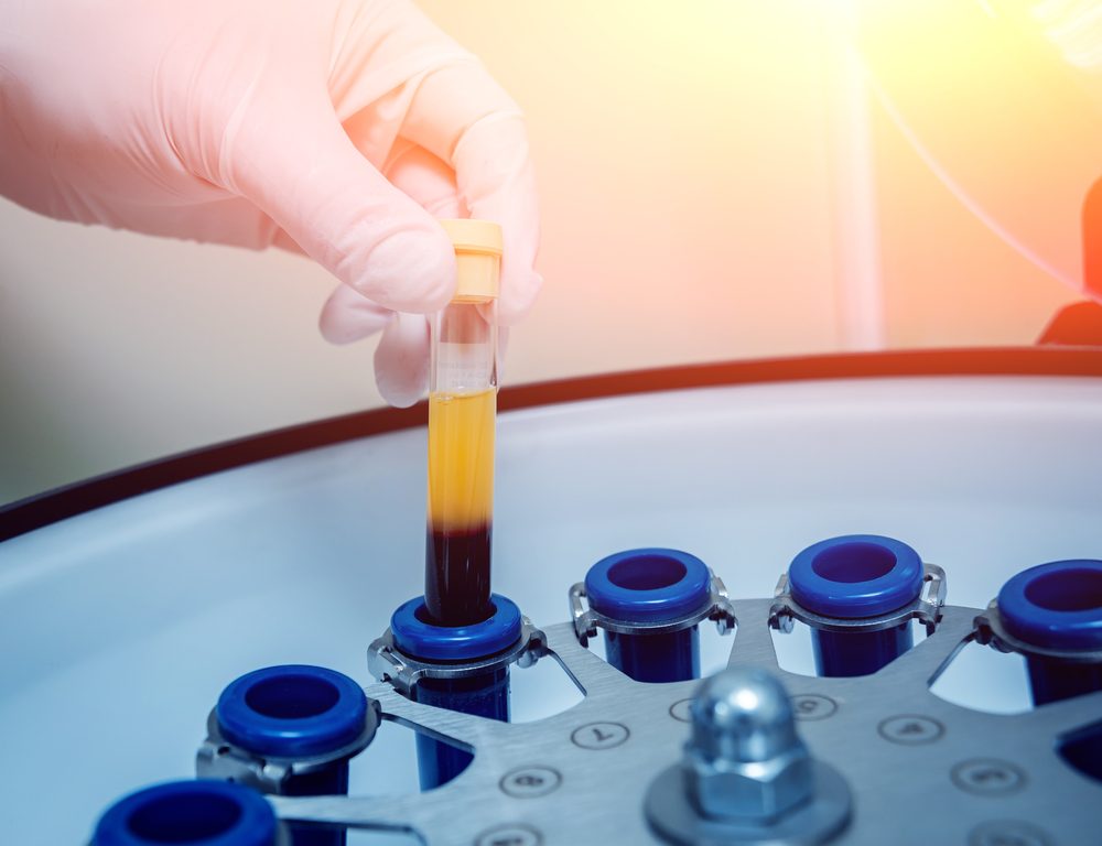 Benefits of Platelet Rich Plasma